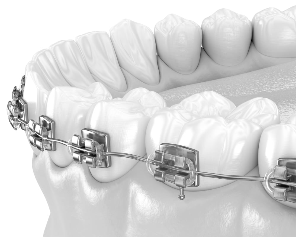 Traditional Metal Braces