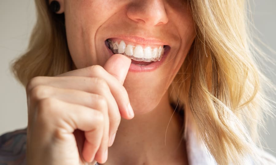 Low-Profile Aesthetics of Invisalign